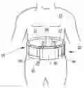 Fig. 01 - Wearable continuous renal replacement therapy device