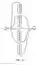 Fig. 06 - Wearable continuous renal replacement therapy device