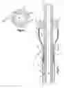 Fig. 04 - Apparatus and method for auto-retroperfusion of a coronary vein