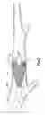 Fig. 07 - Apparatus and method for auto-retroperfusion of a coronary vein
