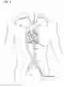 Fig. 05 - Interventional diagnostic catheter and a method for using a catheter to access artificial cardiac shunts
