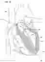 Fig. 06 - Interventional diagnostic catheter and a method for using a catheter to access artificial cardiac shunts