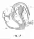 Fig. 02 - Left ventricular conduits to coronary arteries and methods for coronary bypass
