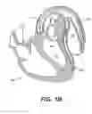 Fig. 03 - Left ventricular conduits to coronary arteries and methods for coronary bypass