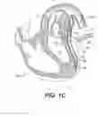 Fig. 04 - Left ventricular conduits to coronary arteries and methods for coronary bypass