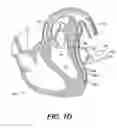 Fig. 05 - Left ventricular conduits to coronary arteries and methods for coronary bypass