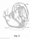 Fig. 07 - Left ventricular conduits to coronary arteries and methods for coronary bypass