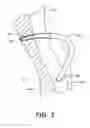 Fig. 08 - Left ventricular conduits to coronary arteries and methods for coronary bypass