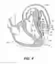 Fig. 09 - Left ventricular conduits to coronary arteries and methods for coronary bypass