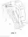 Fig. 10 - Left ventricular conduits to coronary arteries and methods for coronary bypass