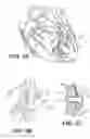 Fig. 11 - Left ventricular conduits to coronary arteries and methods for coronary bypass