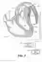 Fig. 16 - Left ventricular conduits to coronary arteries and methods for coronary bypass