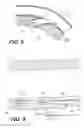 Fig. 17 - Left ventricular conduits to coronary arteries and methods for coronary bypass