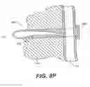Fig. 25 - Left ventricular conduits to coronary arteries and methods for coronary bypass