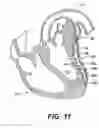 Fig. 31 - Left ventricular conduits to coronary arteries and methods for coronary bypass