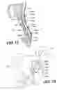 Fig. 32 - Left ventricular conduits to coronary arteries and methods for coronary bypass