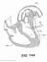 Fig. 33 - Left ventricular conduits to coronary arteries and methods for coronary bypass