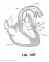 Fig. 34 - Left ventricular conduits to coronary arteries and methods for coronary bypass