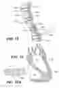 Fig. 35 - Left ventricular conduits to coronary arteries and methods for coronary bypass