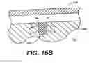 Fig. 36 - Left ventricular conduits to coronary arteries and methods for coronary bypass
