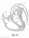Fig. 40 - Left ventricular conduits to coronary arteries and methods for coronary bypass
