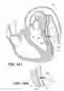 Fig. 41 - Left ventricular conduits to coronary arteries and methods for coronary bypass