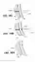 Fig. 42 - Left ventricular conduits to coronary arteries and methods for coronary bypass