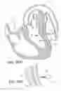 Fig. 43 - Left ventricular conduits to coronary arteries and methods for coronary bypass