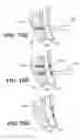 Fig. 44 - Left ventricular conduits to coronary arteries and methods for coronary bypass