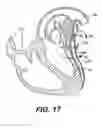 Fig. 45 - Left ventricular conduits to coronary arteries and methods for coronary bypass
