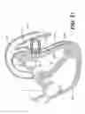 Fig. 49 - Left ventricular conduits to coronary arteries and methods for coronary bypass