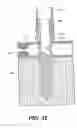 Fig. 60 - Left ventricular conduits to coronary arteries and methods for coronary bypass