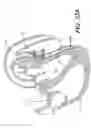Fig. 62 - Left ventricular conduits to coronary arteries and methods for coronary bypass