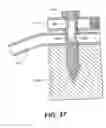Fig. 64 - Left ventricular conduits to coronary arteries and methods for coronary bypass