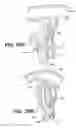 Fig. 66 - Left ventricular conduits to coronary arteries and methods for coronary bypass