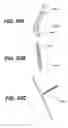 Fig. 82 - Left ventricular conduits to coronary arteries and methods for coronary bypass