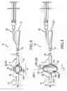 Fig. 05 - Indwelling urinary catheter