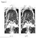 Fig. 03 - Functional image-guided placement of bone screws, path optimization and orthopedic surgery