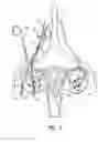 Fig. 05 - Vascular clamp for caesarian section