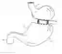 Fig. 01 - Method and device for use in endoscopic organ procedures