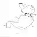 Fig. 02 - Method and device for use in endoscopic organ procedures
