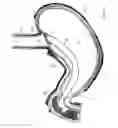 Fig. 10 - Method and device for use in endoscopic organ procedures