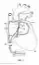 Fig. 13 - Transseptal puncture apparatus