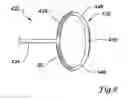 Fig. 05 - Flattened tip filter wire design