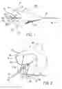 Fig. 02 - Embolic filter frame having looped support strut elements