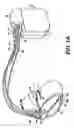 Fig. 02 - Secure and efficacious therapy delivery for an extra-systolic stimulation pacing engine
