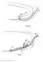 Fig. 02 - Perficardial pacing lead placement device and method