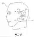 Fig. 07 - Skull-mounted electrical stimulation system