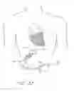 Fig. 30 - Method of manufacturing a cardiac harness