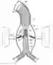 Fig. 01 - Endovascular prosthesis, system and method